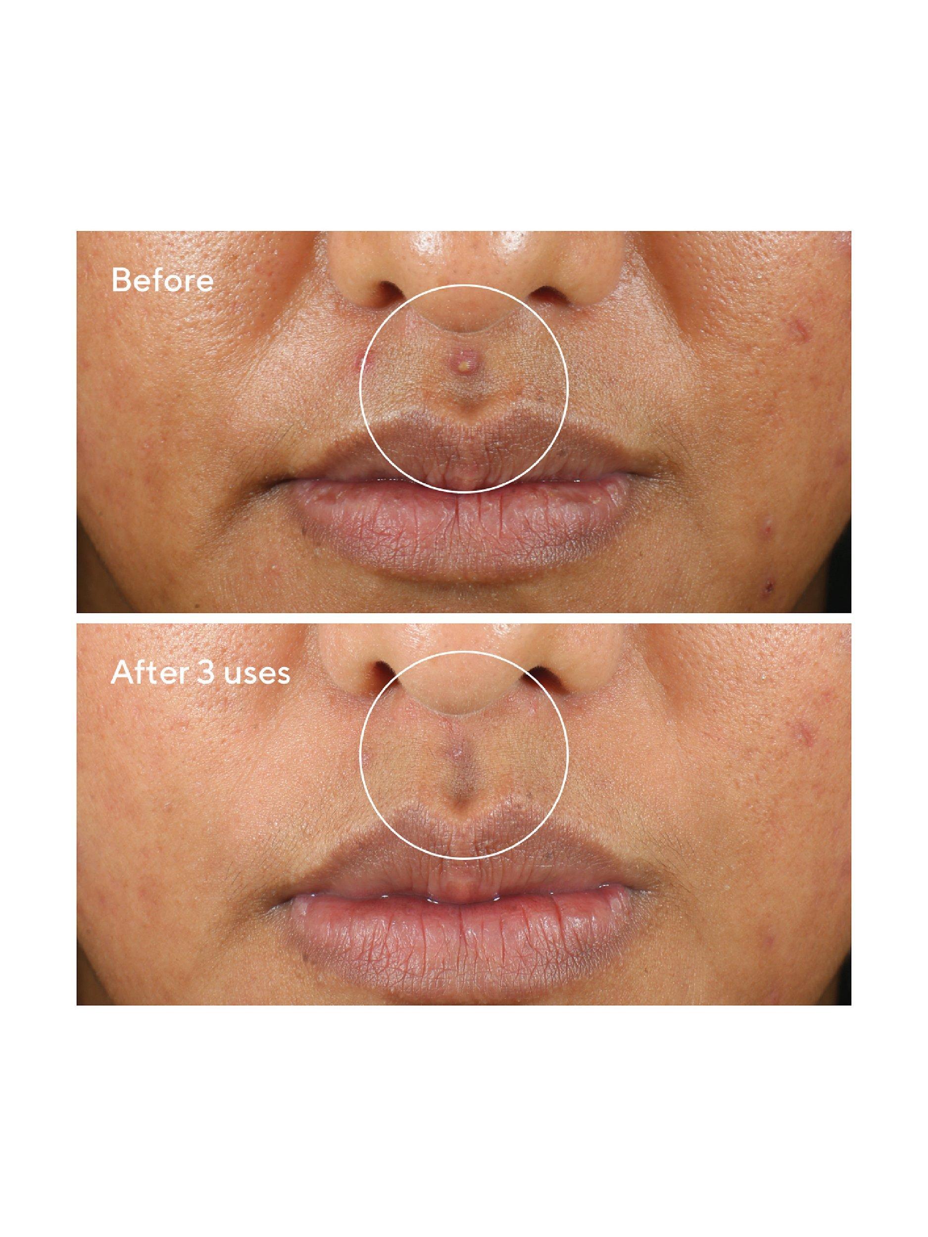 Product image 3 of 5, which shows Murad Rapid Relief Sulfur Mask, 75ml