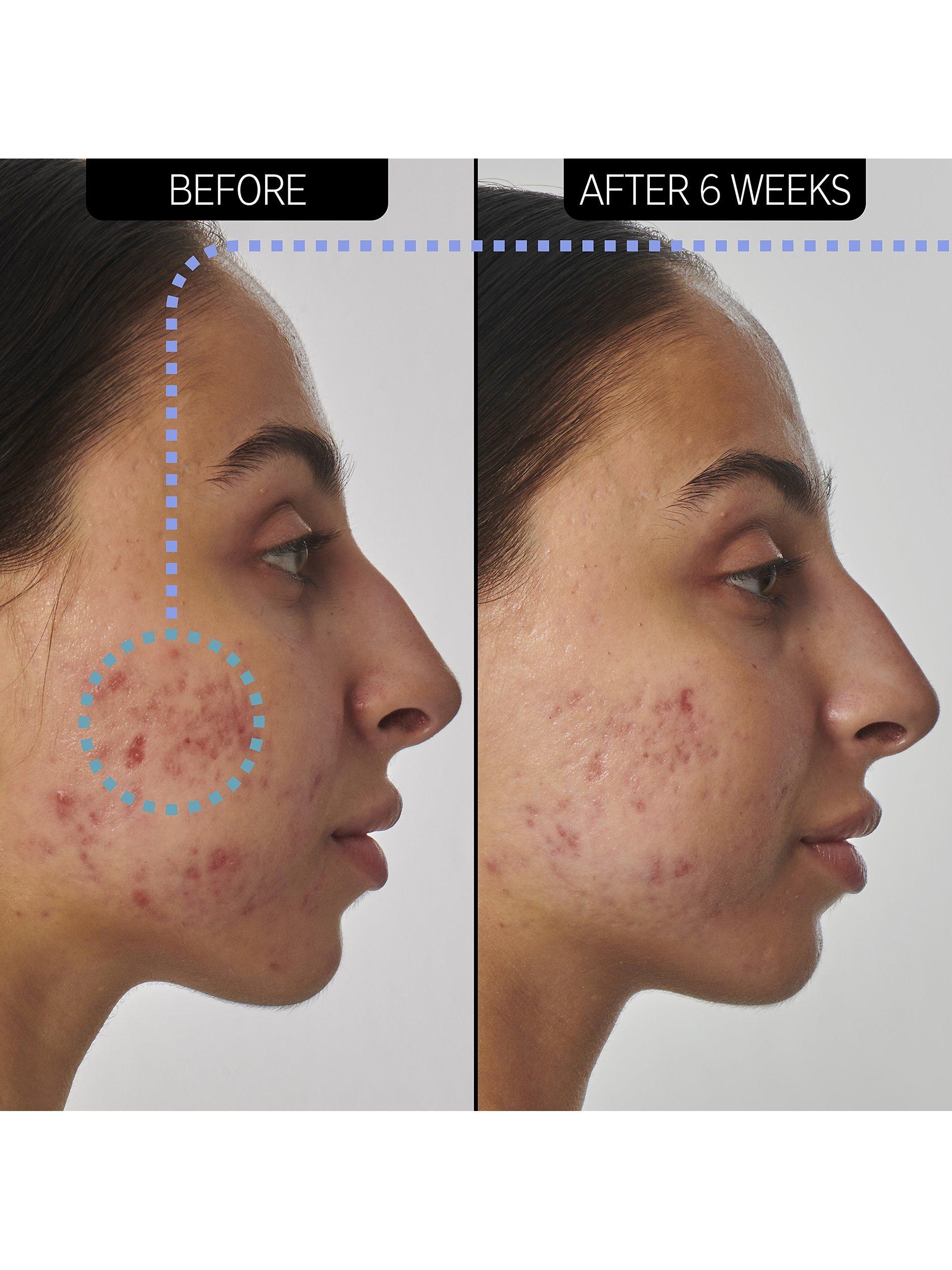 Product image 3 of 5, which shows The INKEY List  Super Solutions 1% Retinol Scar, Mark and Wrinkle Solution, 30ml