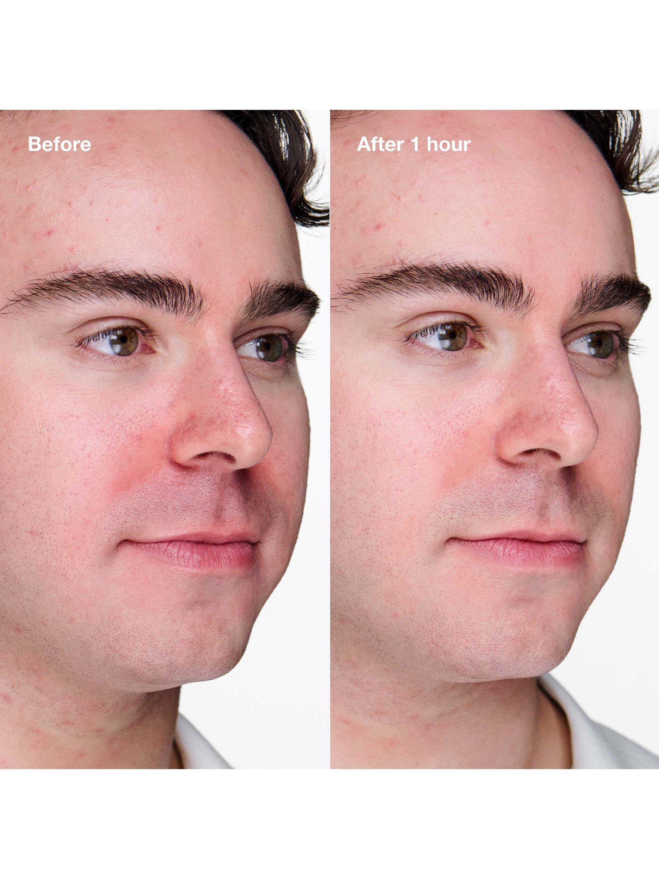 Product image 4 of 8, which shows Clinique Anti-Blemish Solutions Clinical Advanced Clearing Gel, 10ml