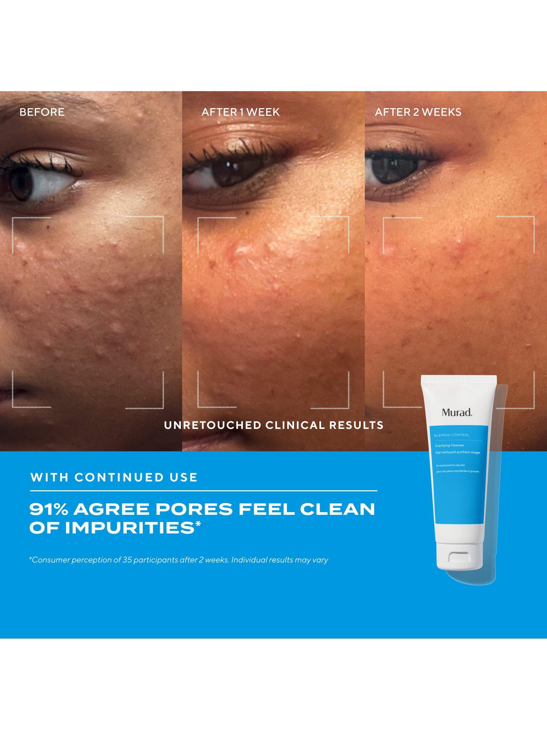 Product image 3 of 8, which shows Murad Blemish Control Clarifying Cleanser, 148ml