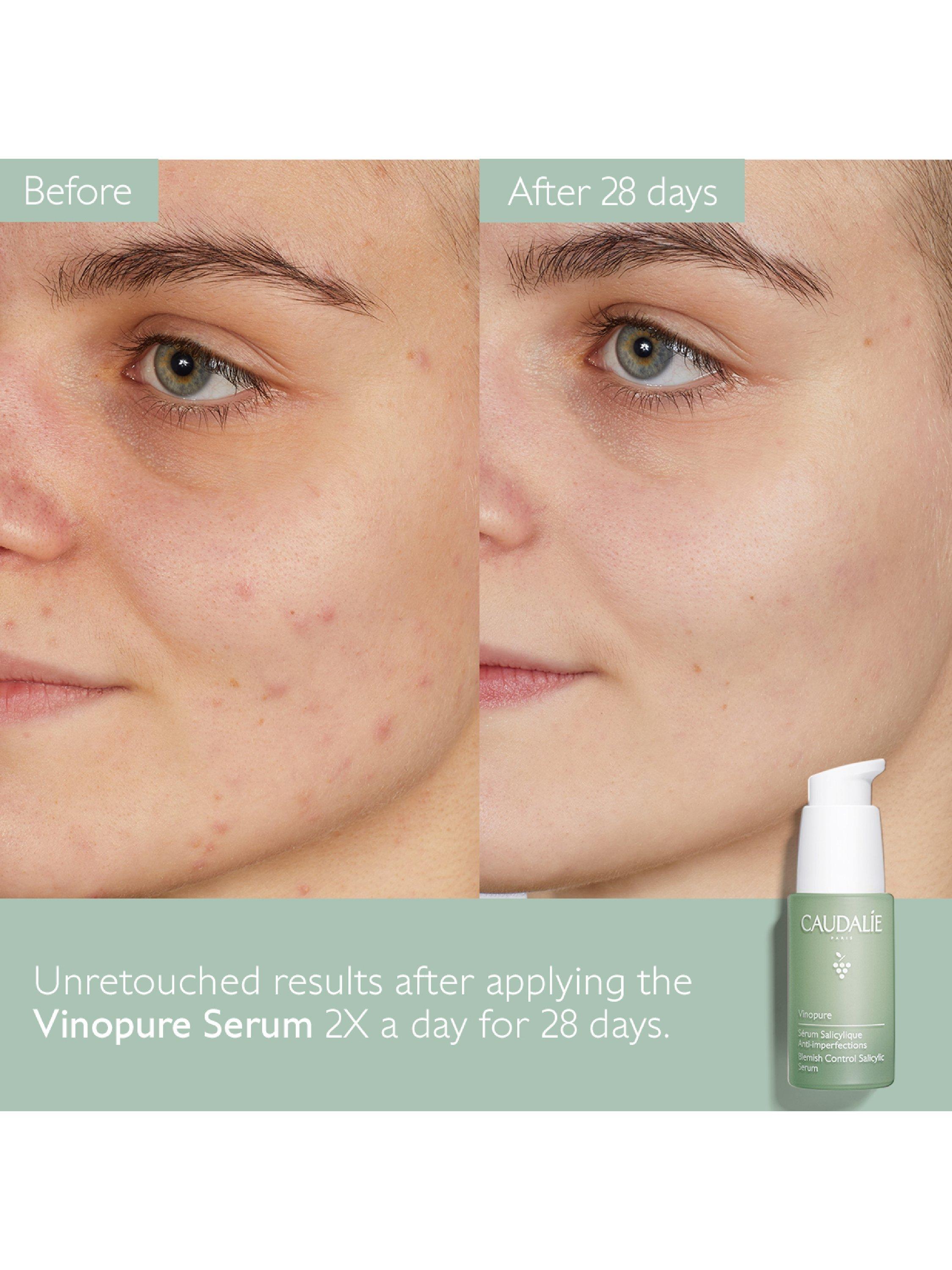 Caudalie Vinopure Blemish Control Salicylic Serum, 30ml