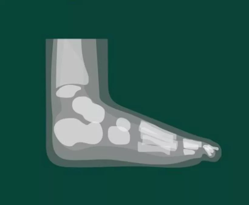 Illustration of foot X-ray showing fractured metatarsal bones, ankle and toes on a dark green background