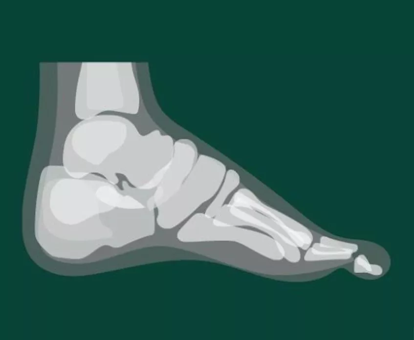Side view X-ray illustration of a human foot showing bones, joints and toes, medical anatomy graphic on green background